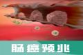 从肠息肉到肠癌，扼杀它别错过“黄金10年”窗口期！