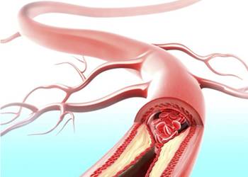 高尿酸的4大危害3