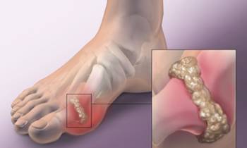 高尿酸已成第四高！致病危害不容小觑