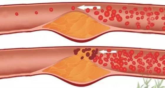这根血管最易堵！一堵就中风！千万别等半身不遂才知道!
