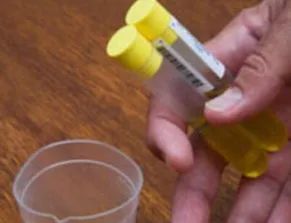 体检的验尿能验出什么？